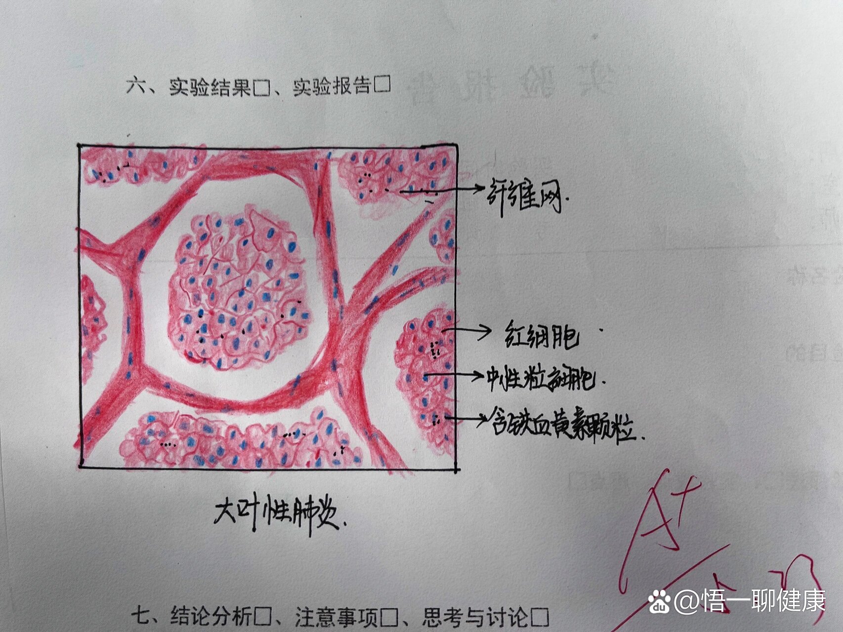 肺脓肿病理切片手绘图图片