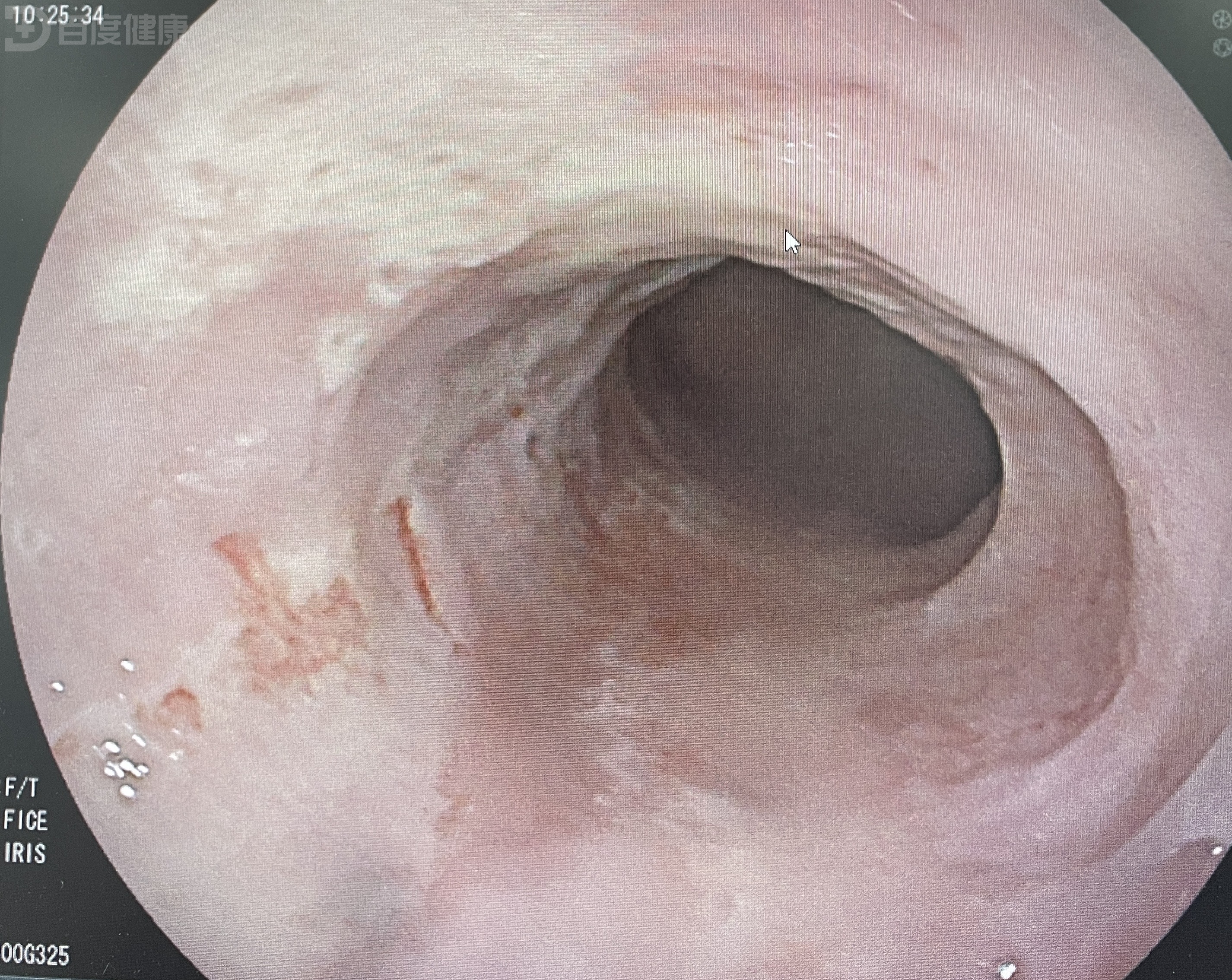 食管癌晚期胃镜图片图片