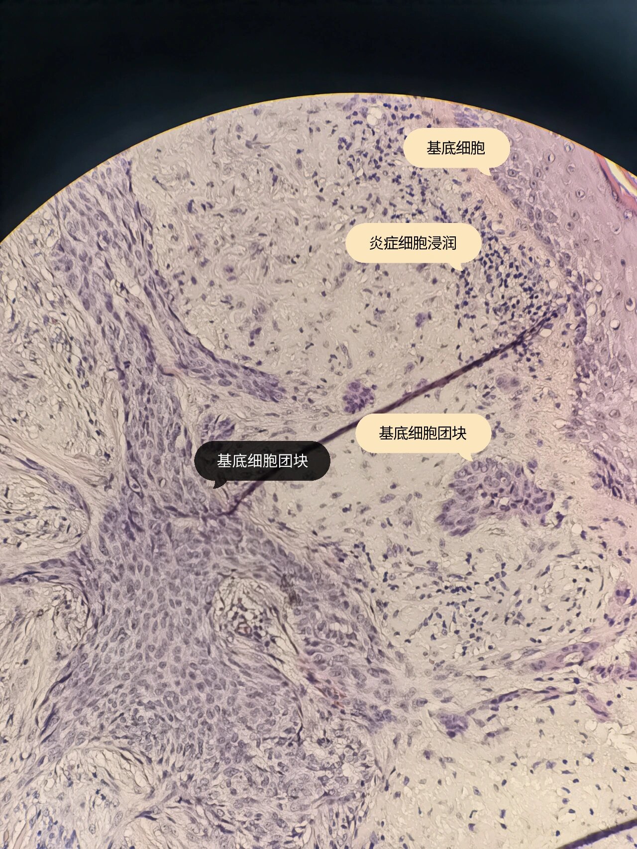皮肤病理丨基底细胞癌