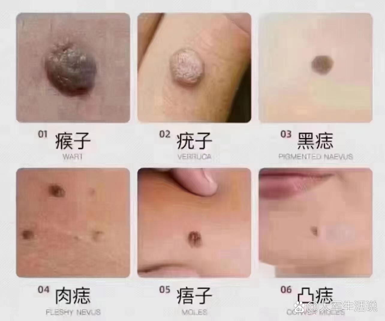 【痣,疣分享】温馨提醒