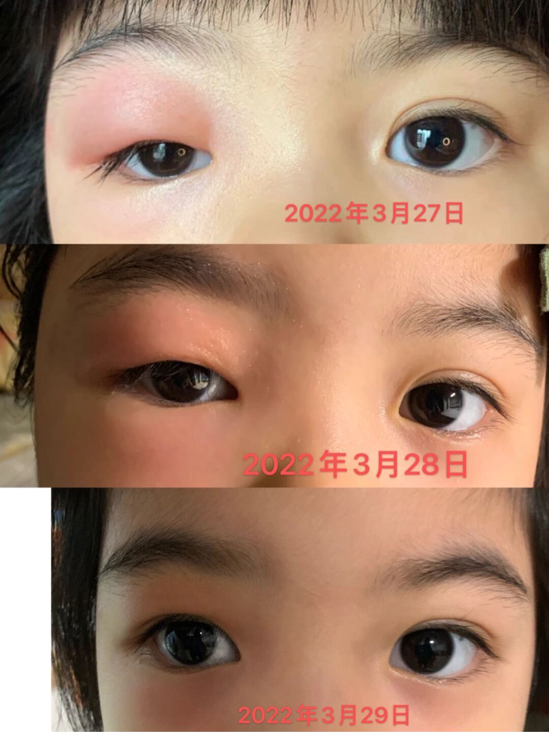 被蚊子咬到眼睛红肿了?