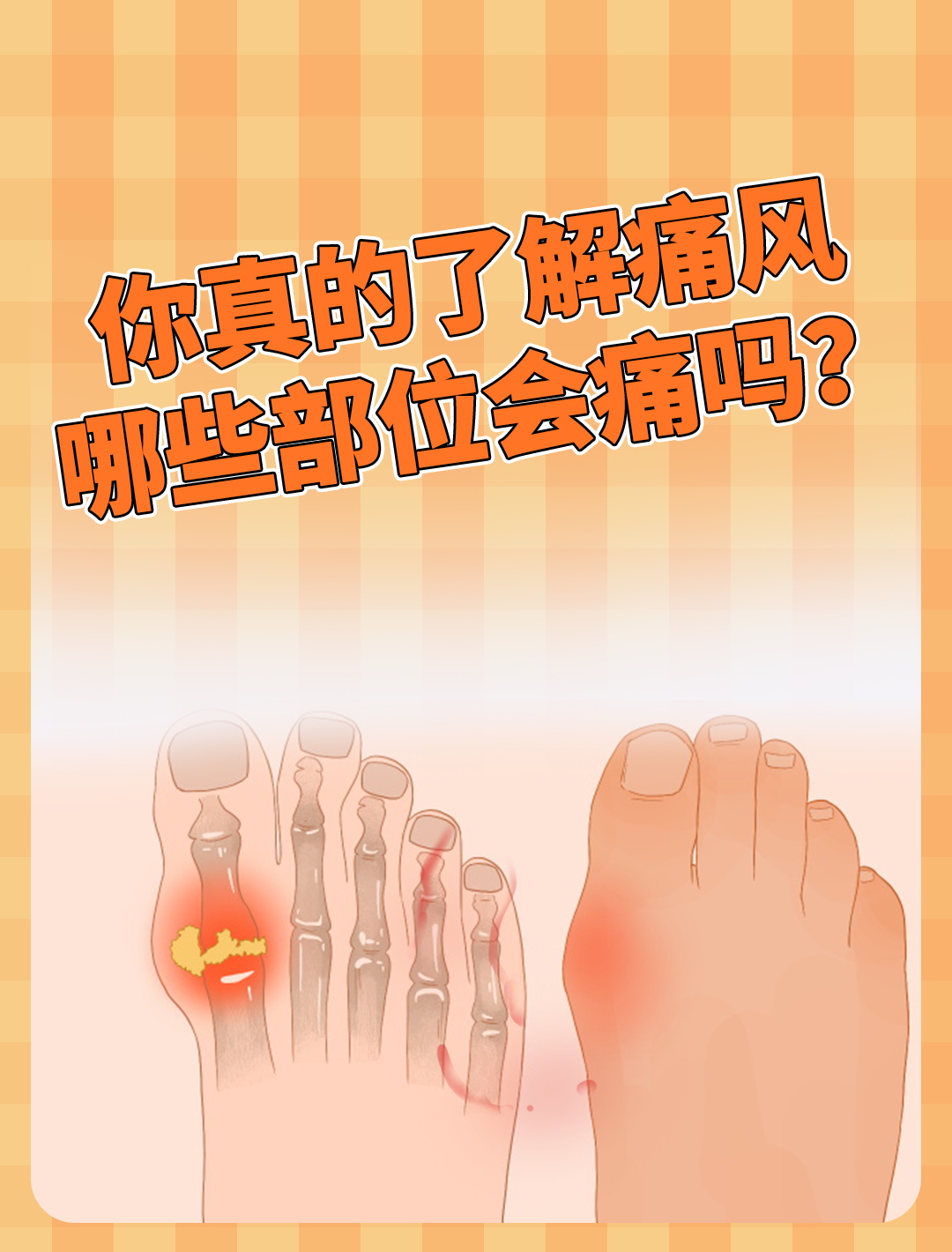 你真的了解痛风哪些部位会痛吗?