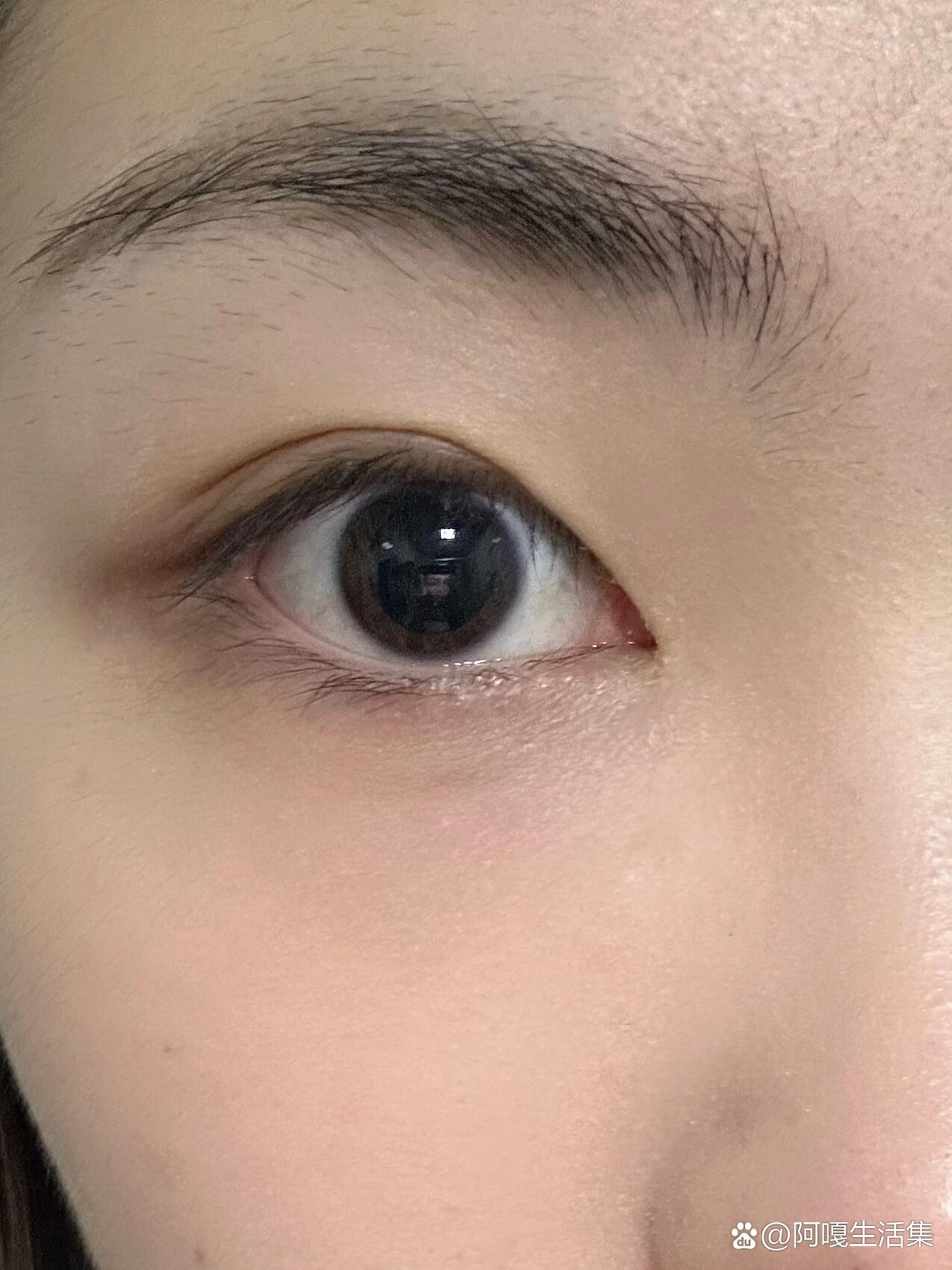 散瞳五小时还没恢复