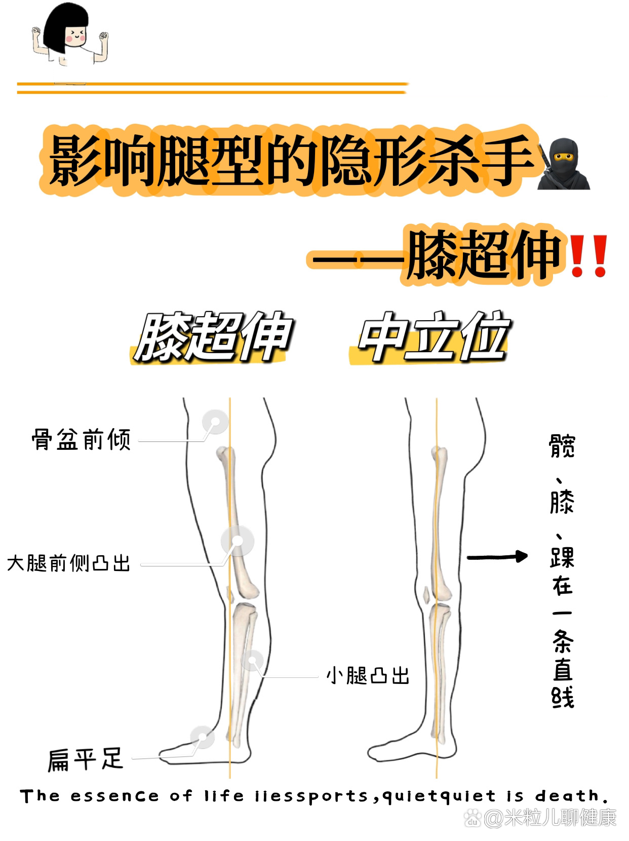 影响腿型的隐形杀手03——膝超伸7515