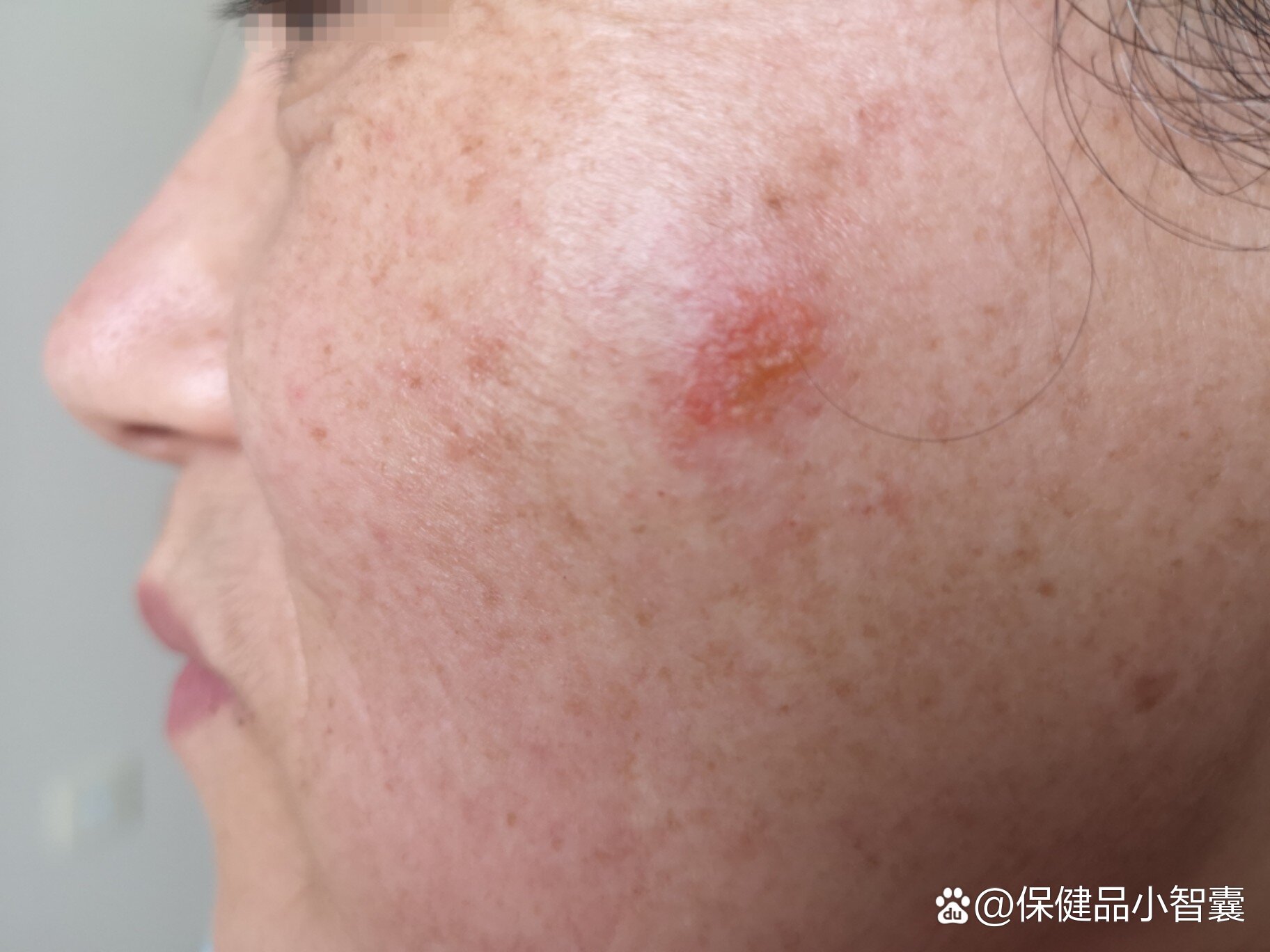 "排毒","抑菌",最后却成了激素脸!