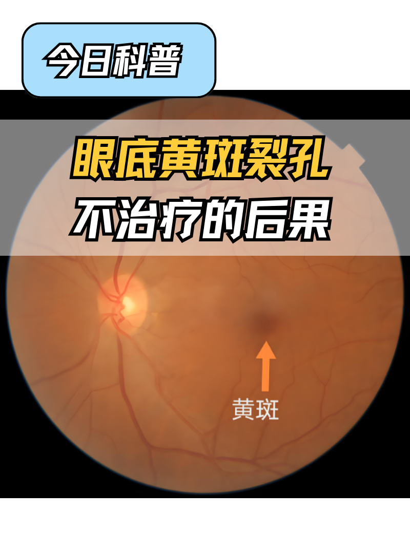 今日科普眼底黄斑裂孔不治疗的后果