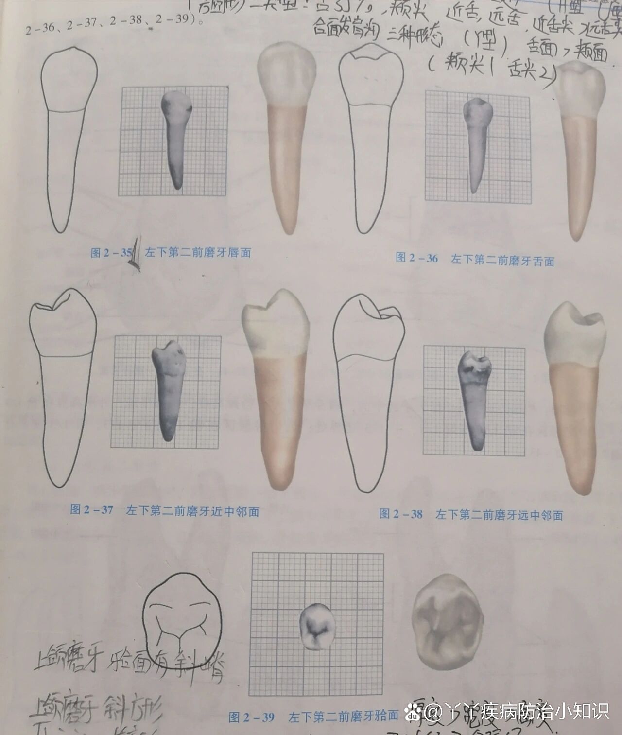 相近(颊尖舌尖不明显) br>2    近远中点隙相距较近,中央沟短 br>3