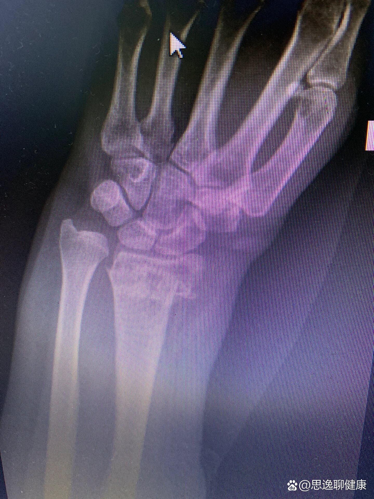 左侧桡骨远端骨折错位,复位后40天拆除固定