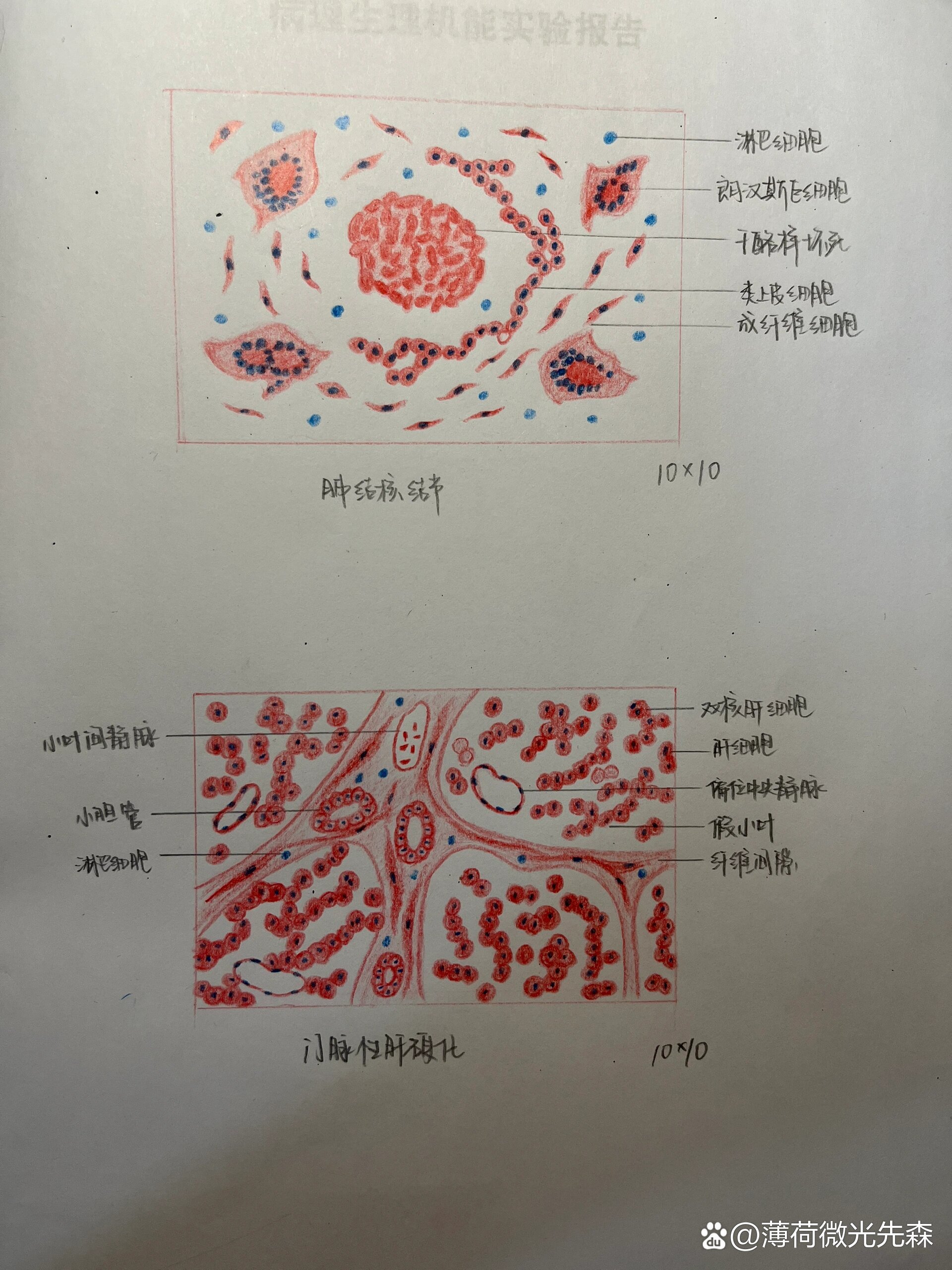 结核结节病理手绘图图片