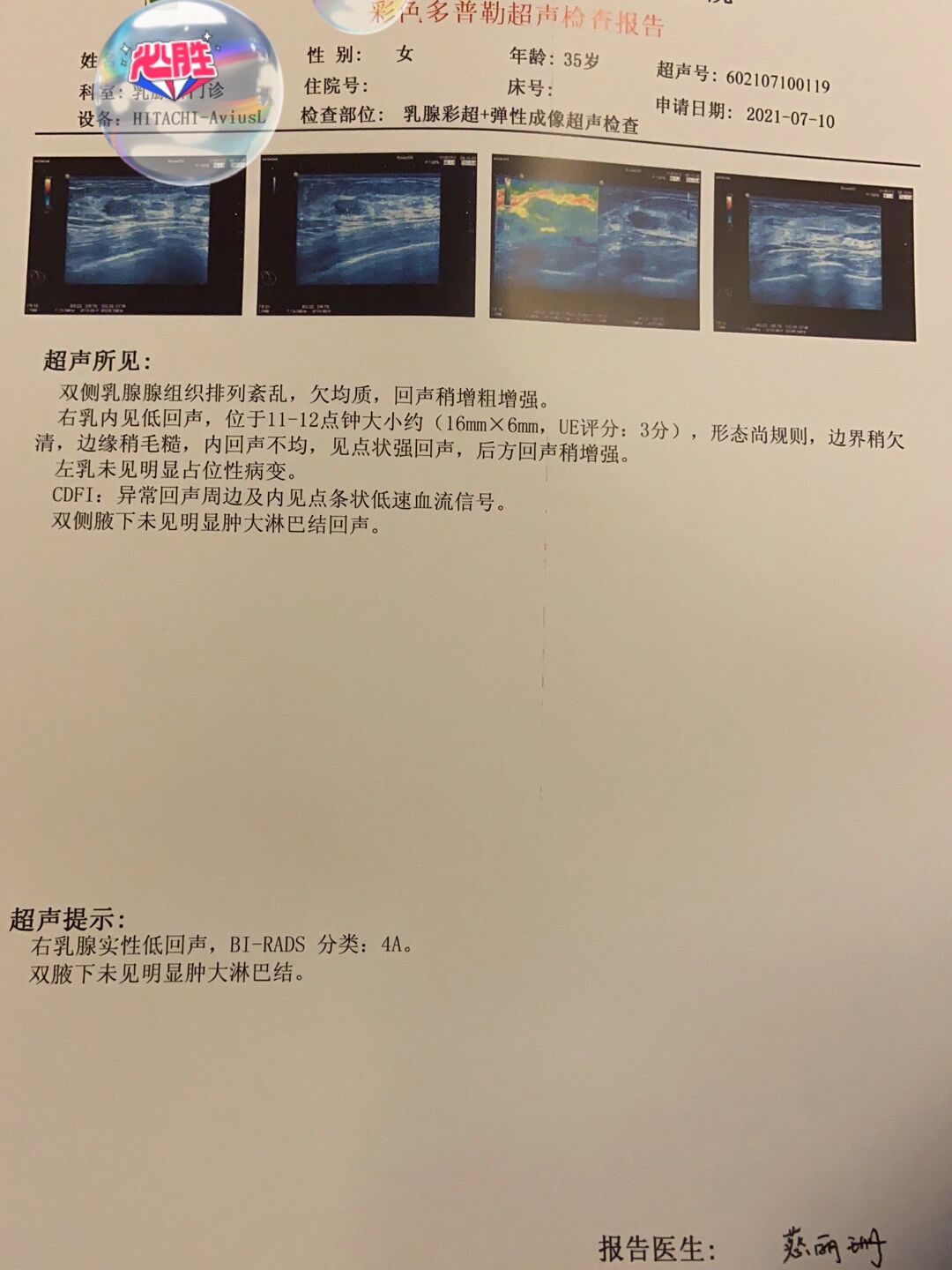 乳腺良性肿瘤4a切除