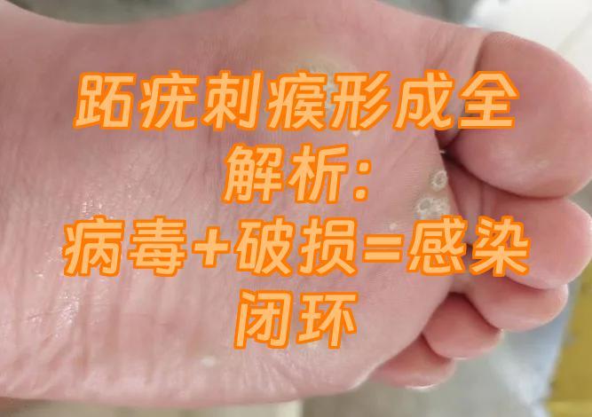 跖疣刺瘊形成全解析：病毒+破损=感染闭环