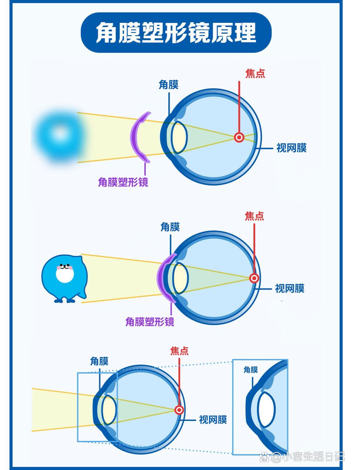 角膜塑形镜展板图片