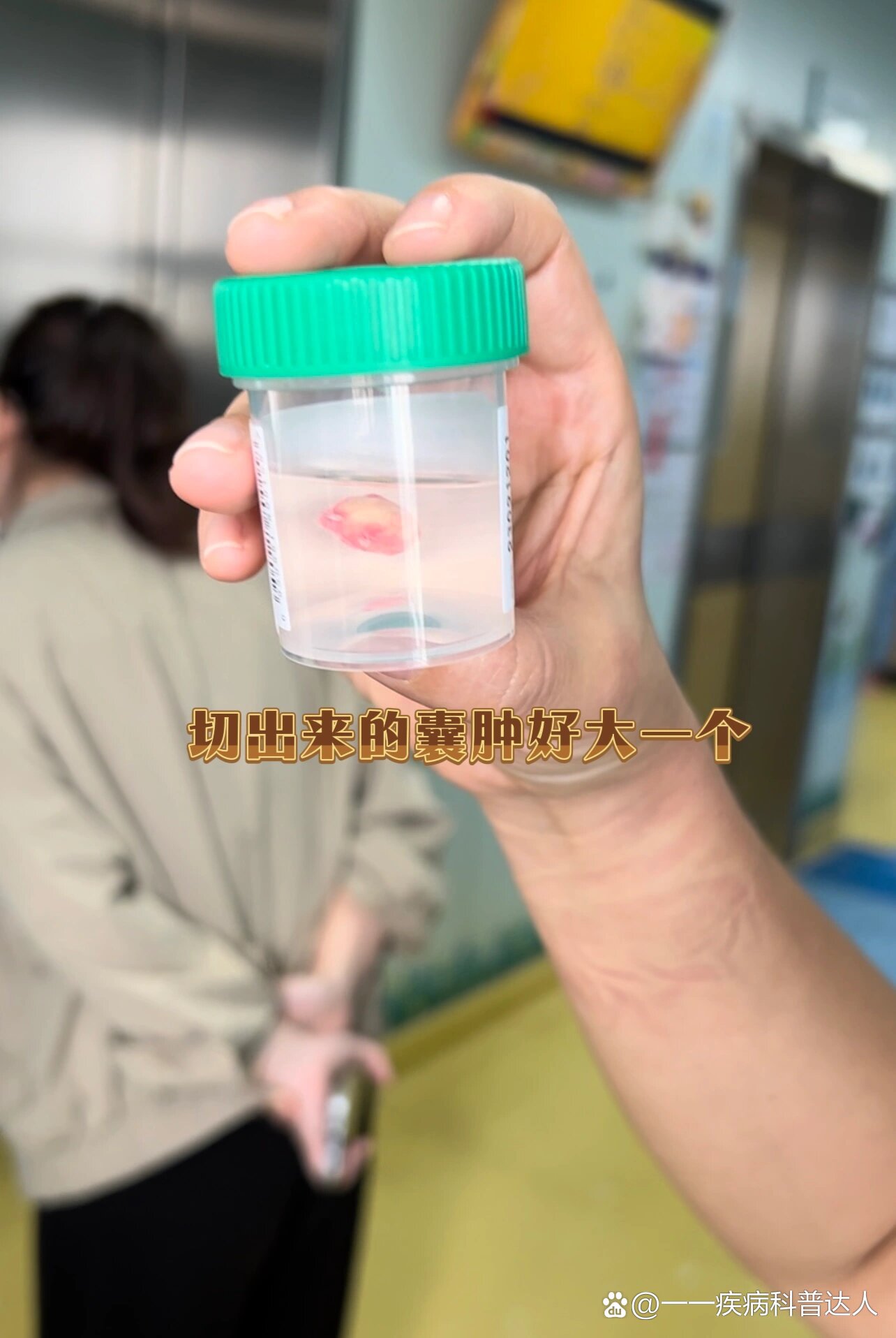 皮样囊肿/眉弓囊肿10个月宝宝终于拿掉