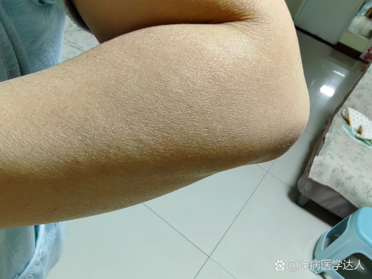 胳膊肘皮肤干皮