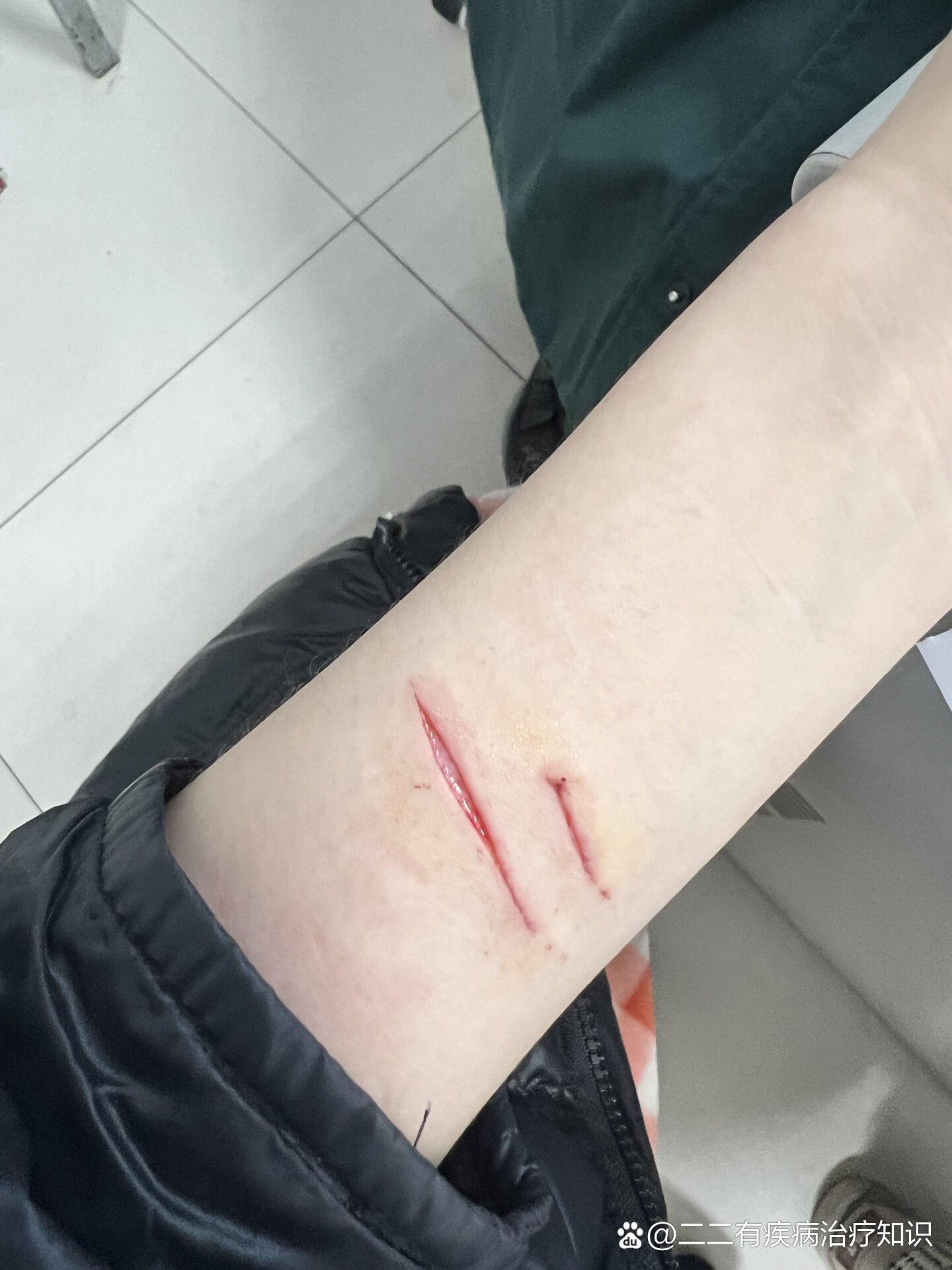 不缝针的情况多久能恢复好?