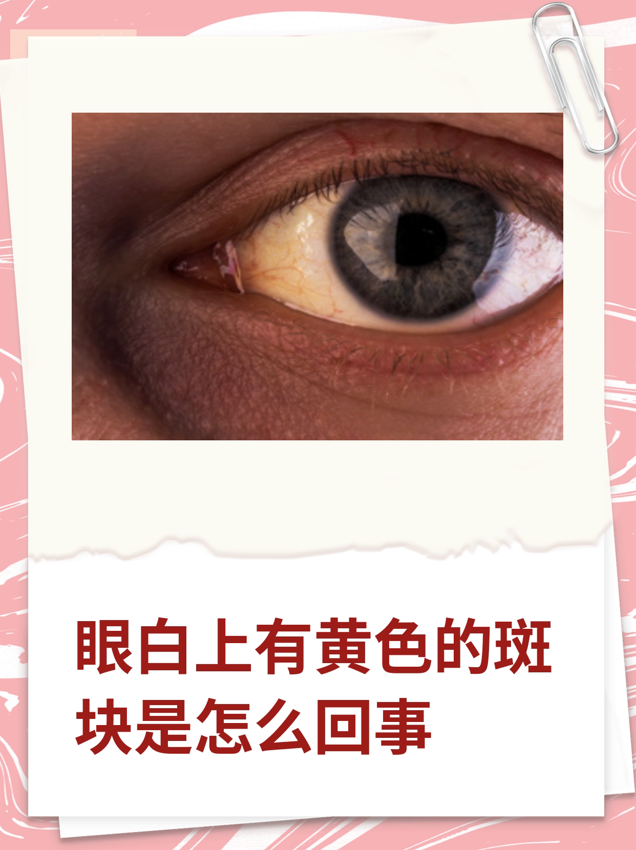  p>"我的眼睛最近出现了黄斑点点96,而且感觉视力也有点模糊.