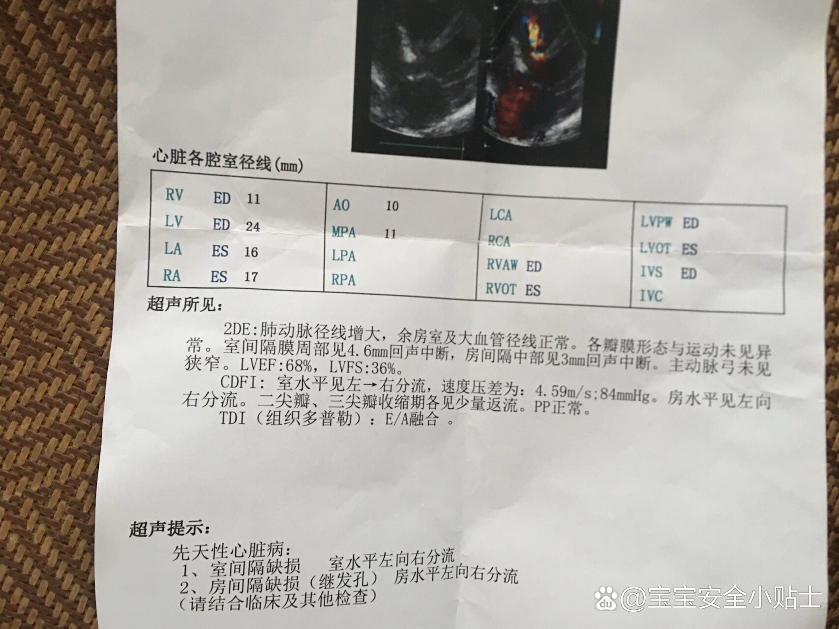 一周岁先心宝宝房缺室缺自愈