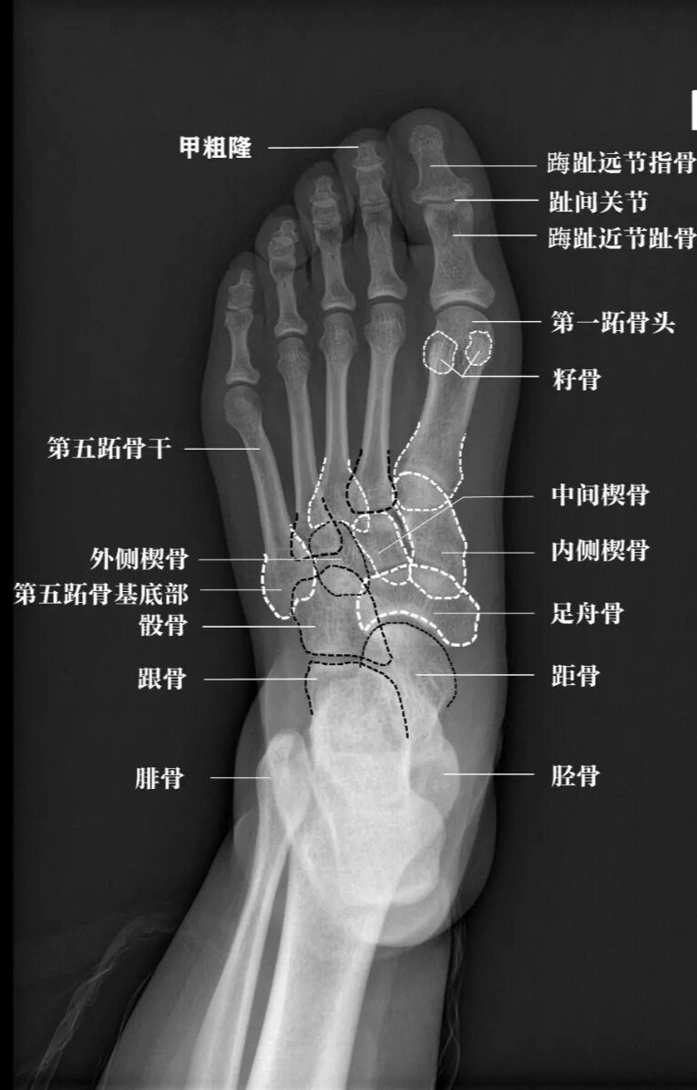 正常左脚踝x光片图解图片