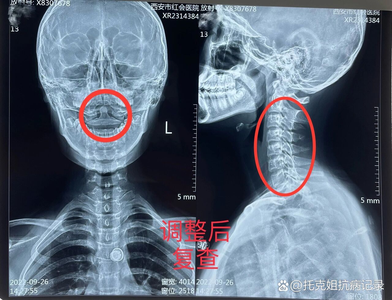 颈椎旋转活动受限,x提示寰枢关节脱位,行手法复位一周后复查,关节回位
