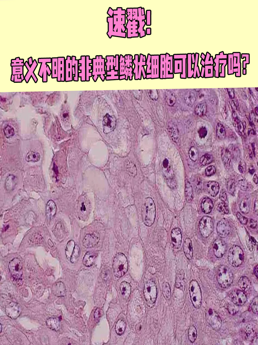 速戳!意义不明的非典型鳞状细胞可以治疗吗?