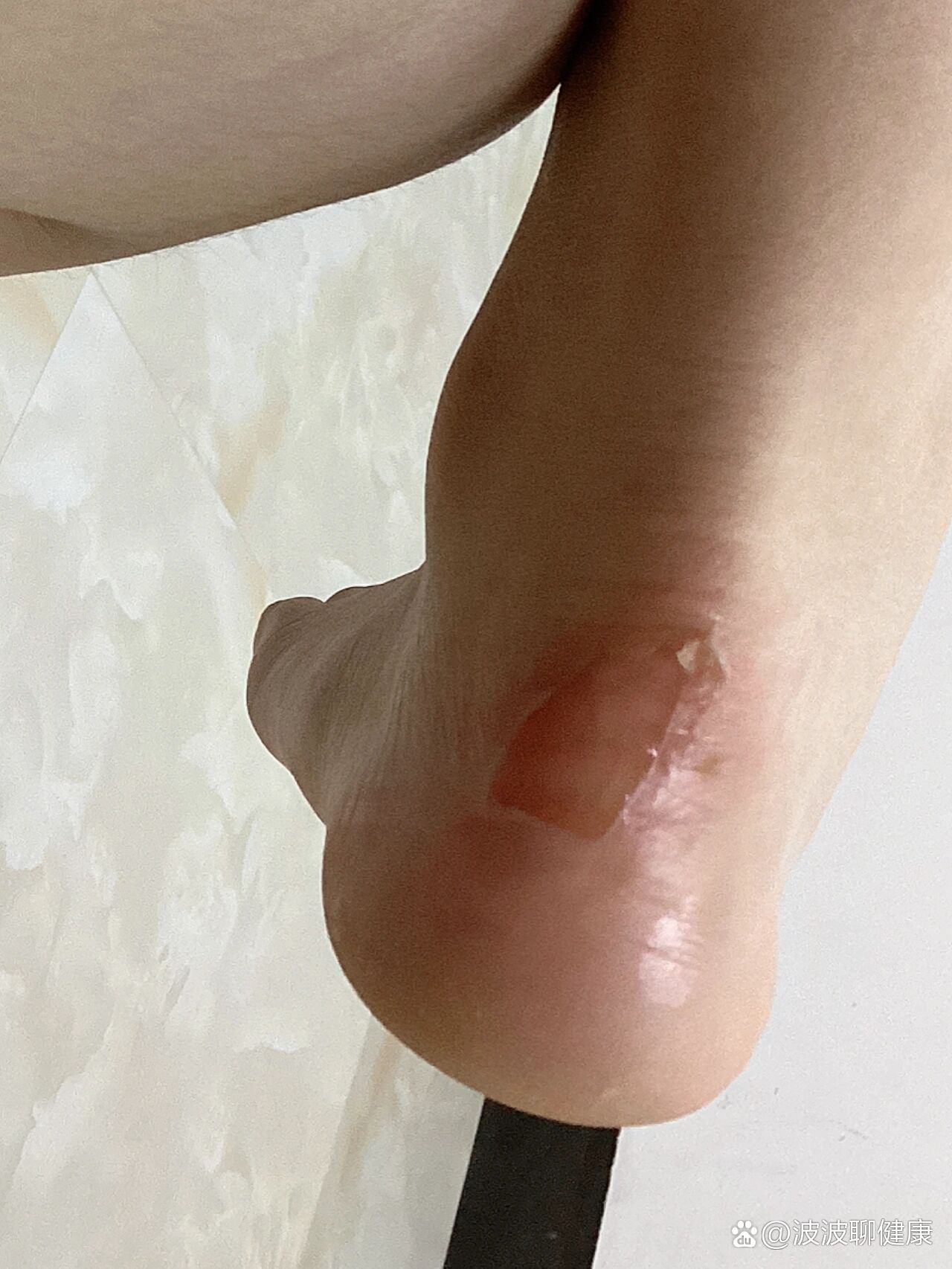 脚后跟磨成这样需要涂点什么