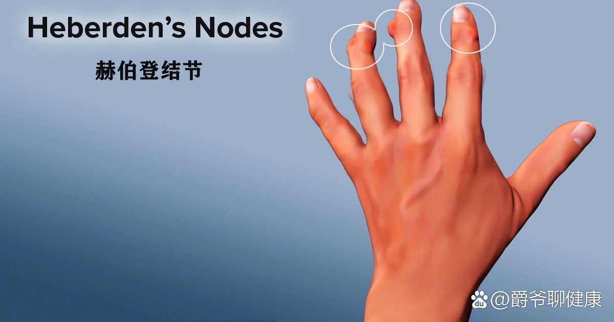 晨起双手发胀,僵硬,握不拢