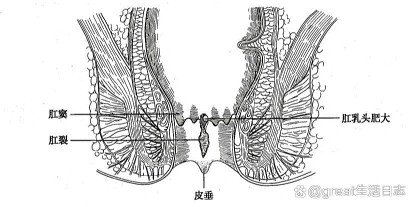 肛裂什么样子图片图片