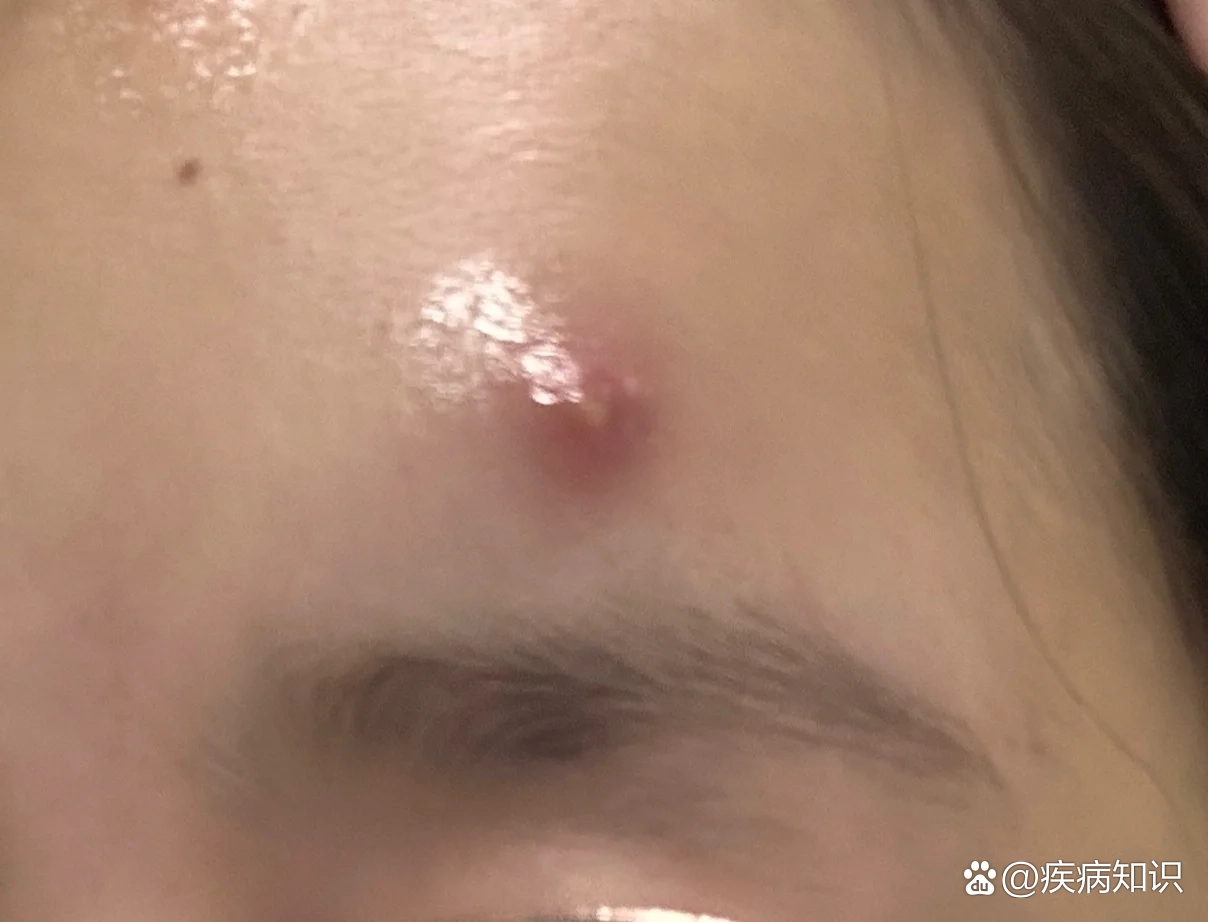 额头长大痘痘真的好痛!