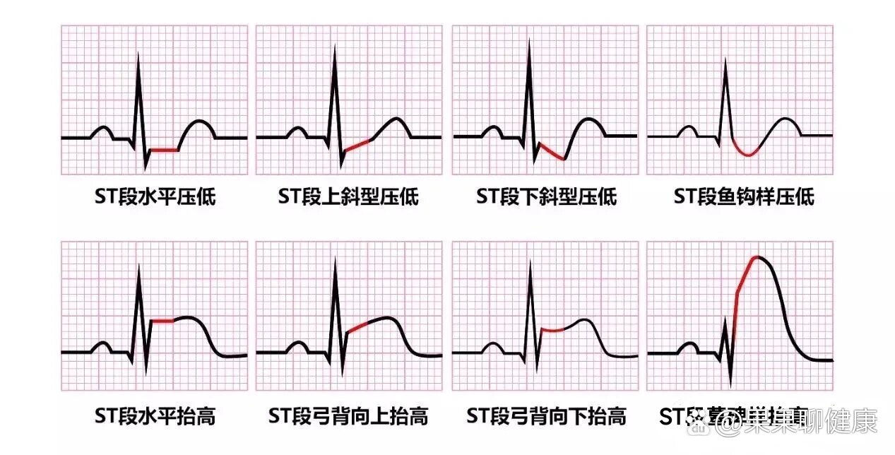 纯干货,一文看懂st段压低与抬高