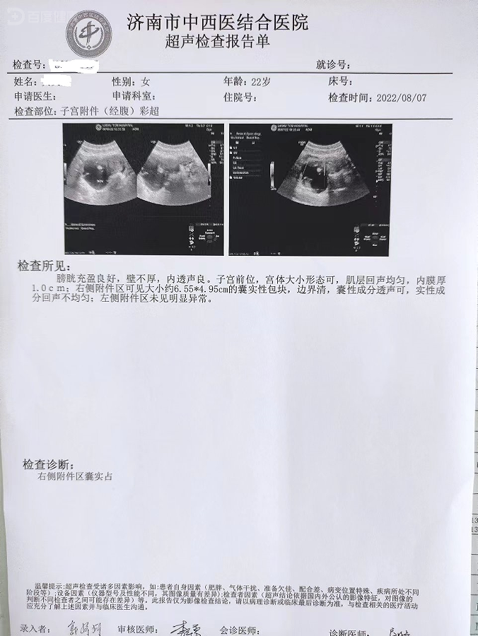 卵巢纤维瘤超声图片图片