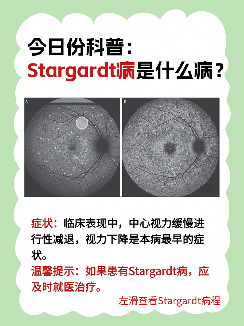 今日份科普:stargardt病是什么病?