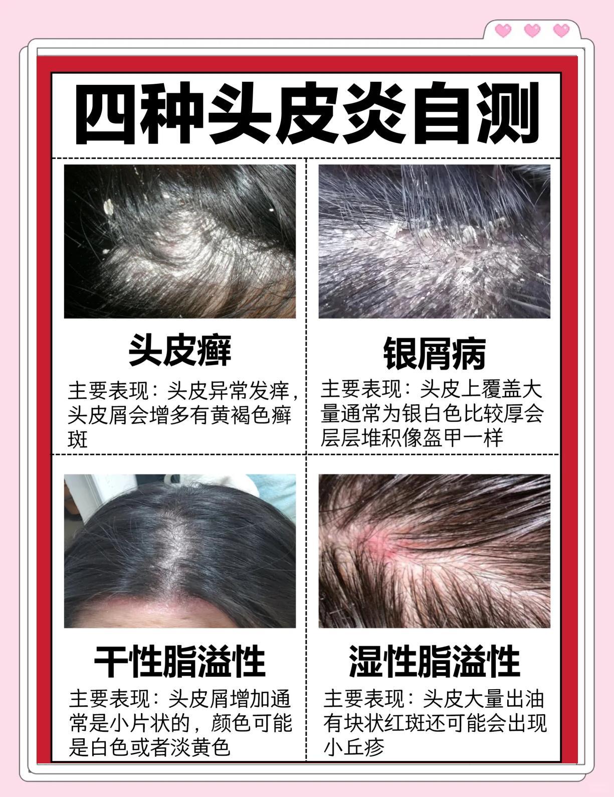 🧐4种头皮炎症自测指南！