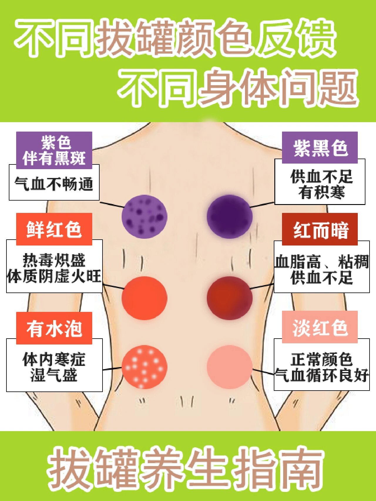 拔罐颜色代表什么,拔罐颜色越深毒越多?