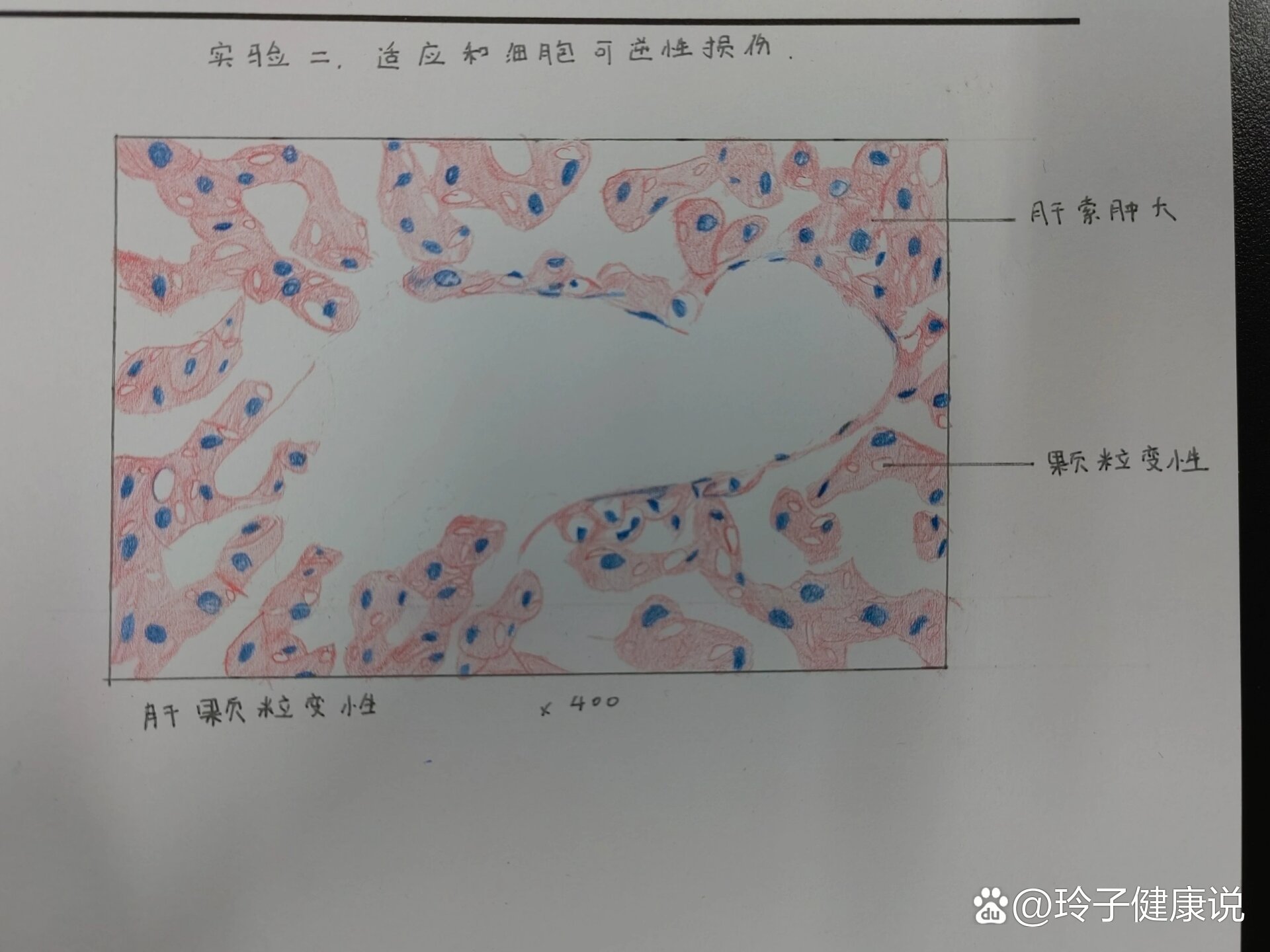 绘制肝硬化镜下红蓝图图片