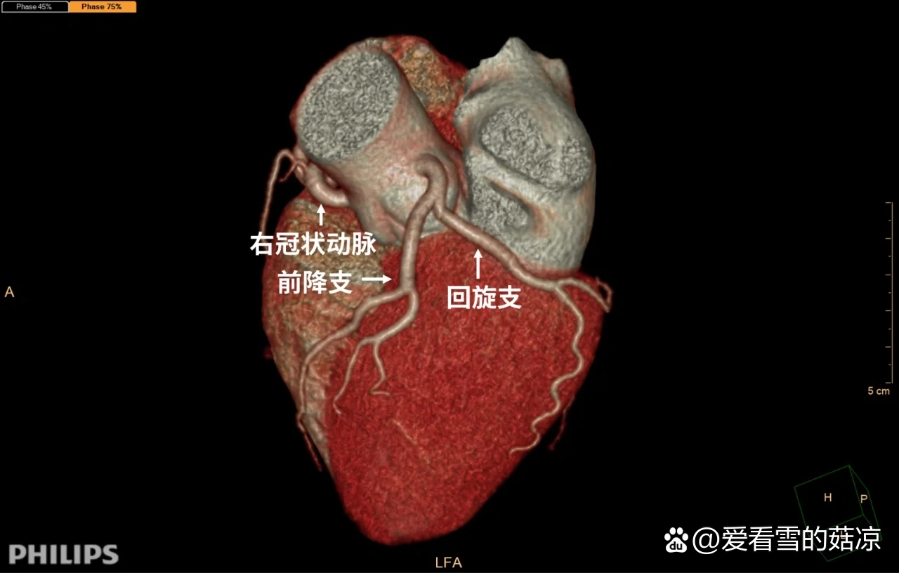 右回旋支图片