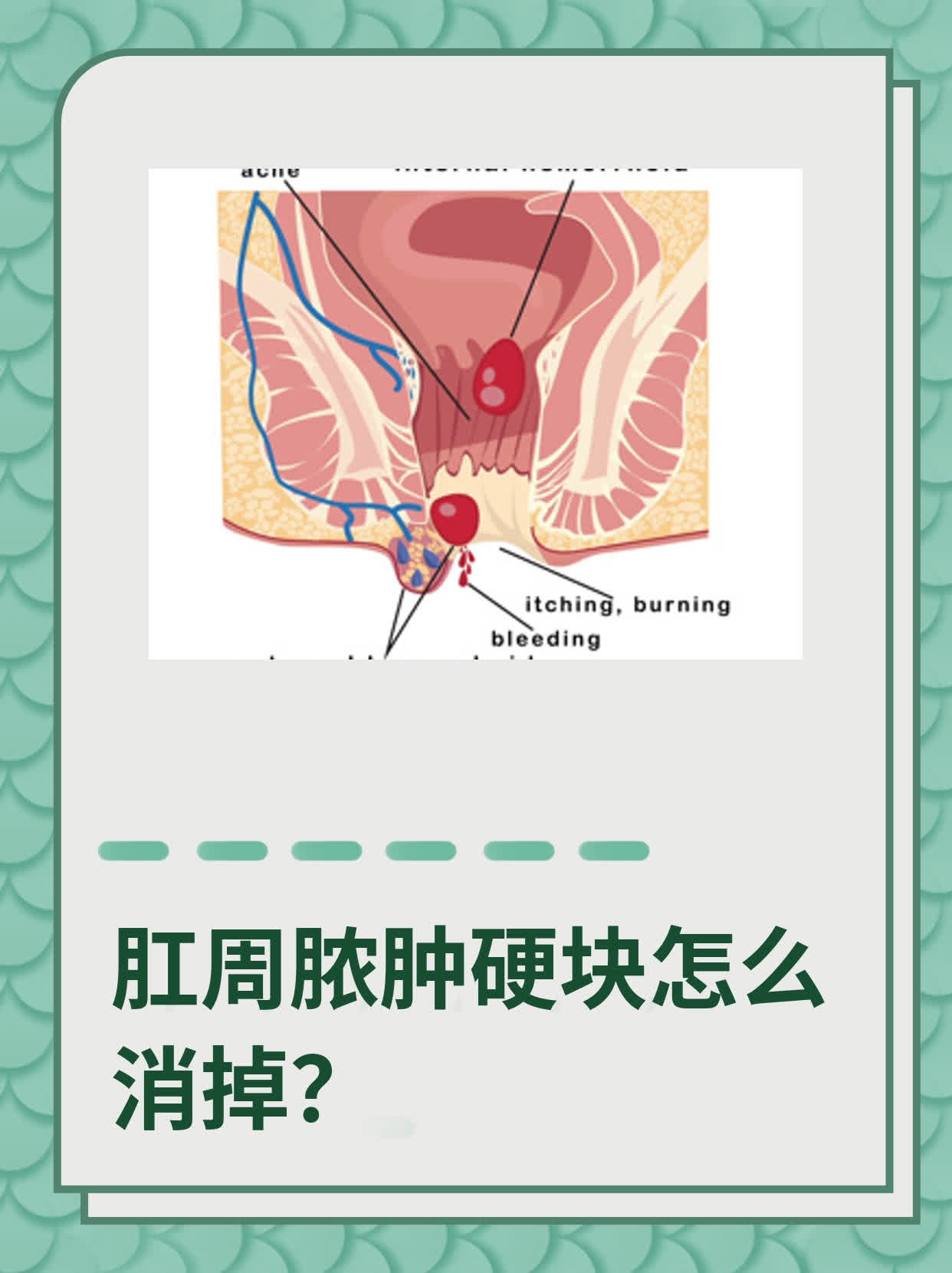 肛周脓肿只有硬块没脓图片