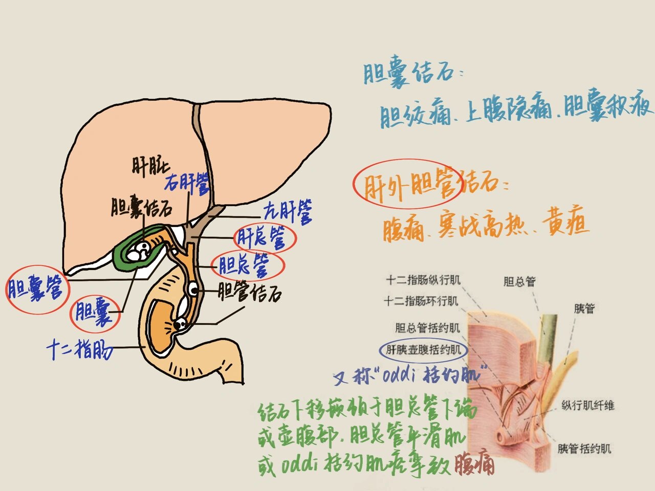 胆结石