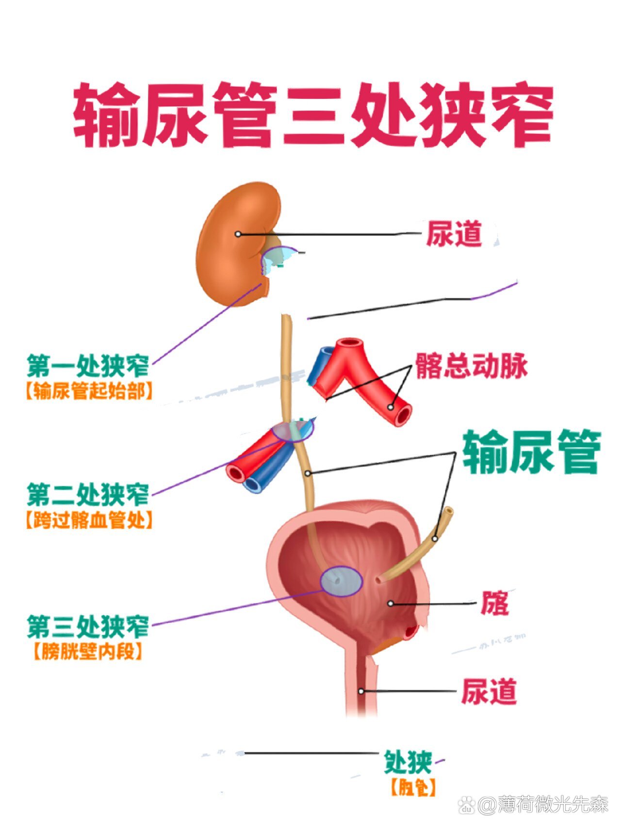 输尿管狭窄解剖图图片