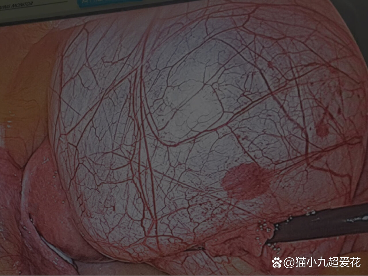 巨大的输卵管系膜囊肿