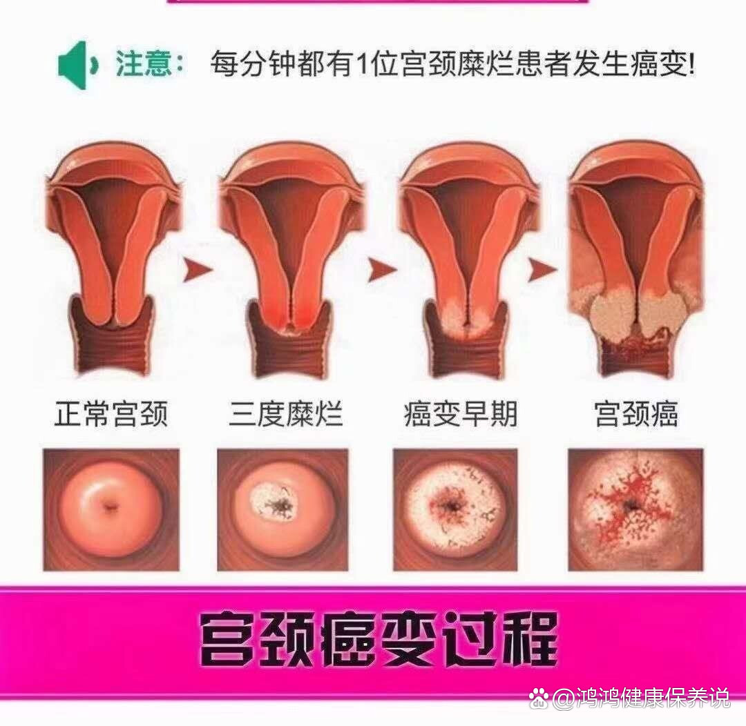 宫颈糜烂2度严重吗图片