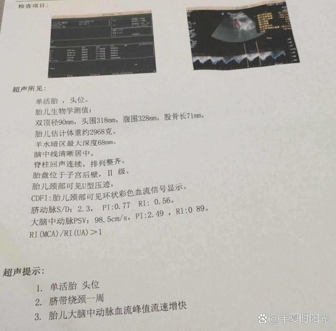 胎儿大脑中动脉血流峰值流速增快