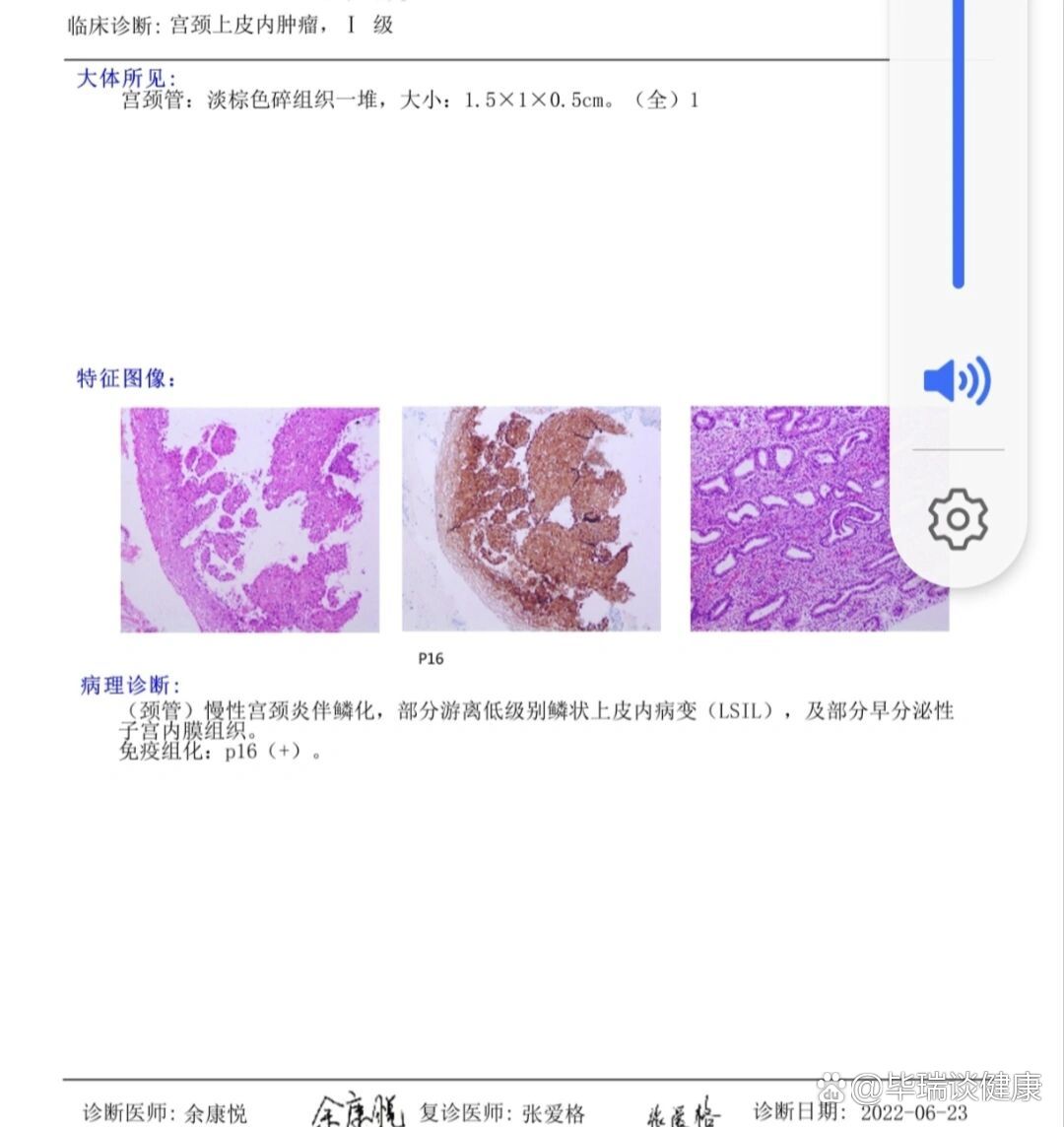 图一是之前的活检报告,宫颈管骚刮实在太痛太不舒服了,一个棍子从下面