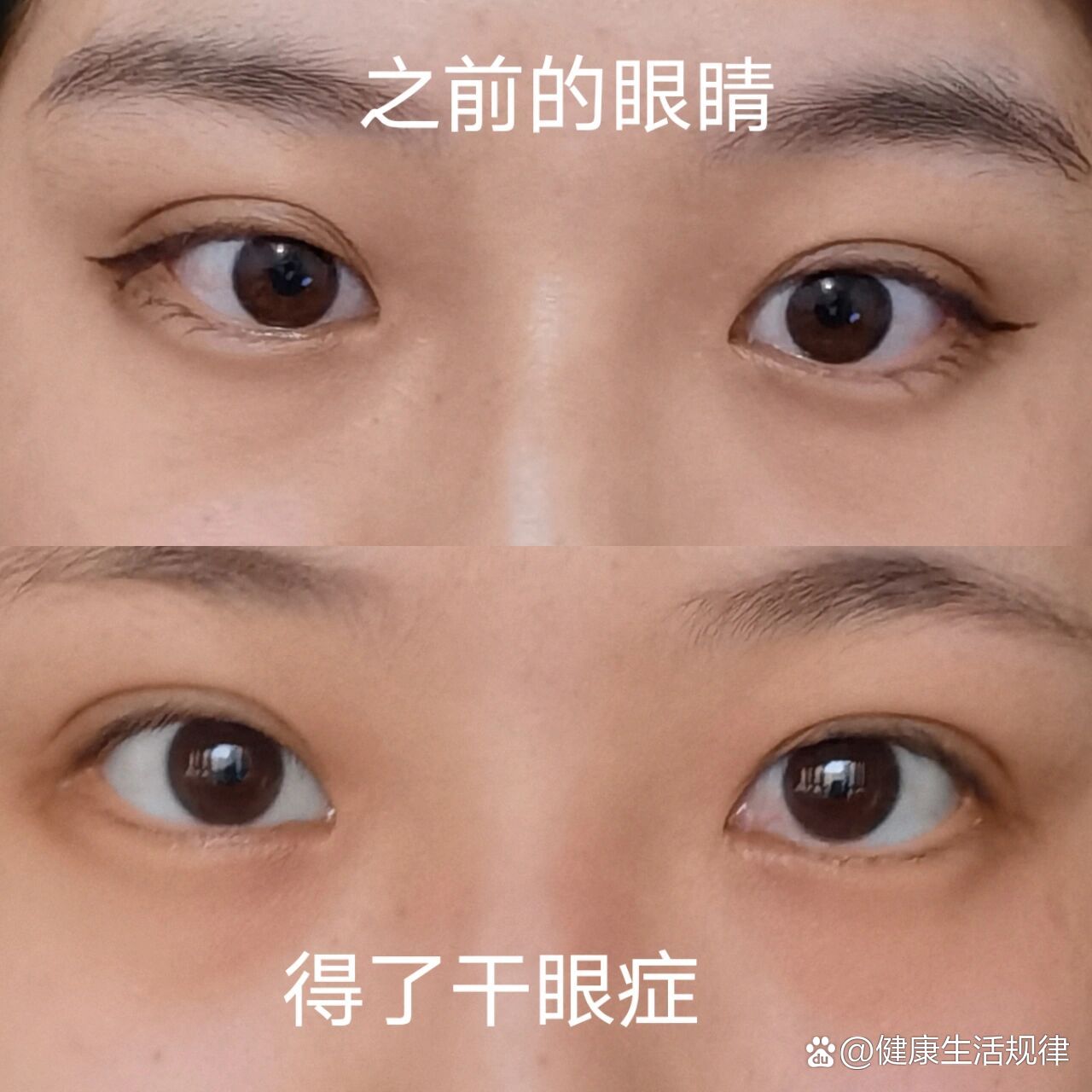 干眼症的一些症状