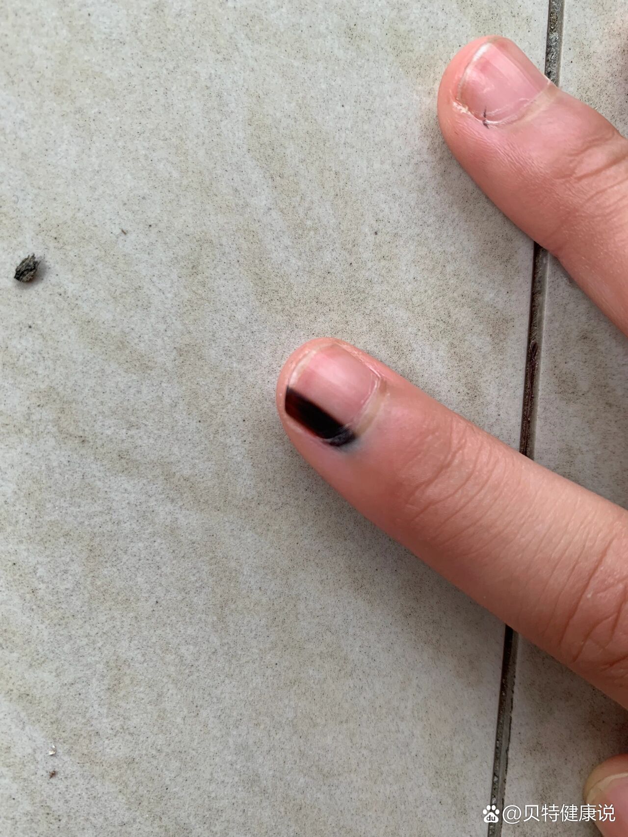 求知道哪里做甲母痣做得好的医院