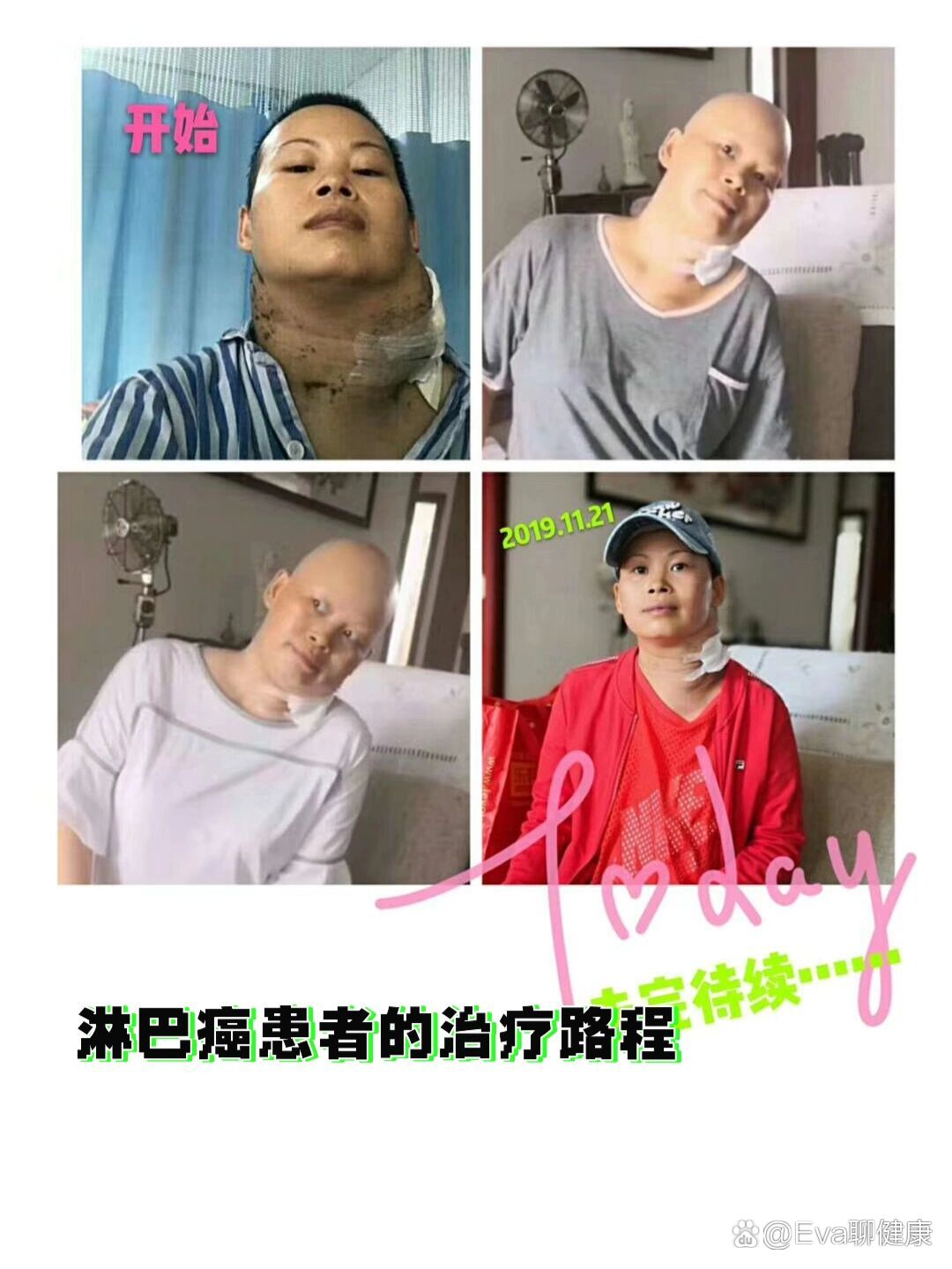 淋巴癌治疗的对比照片