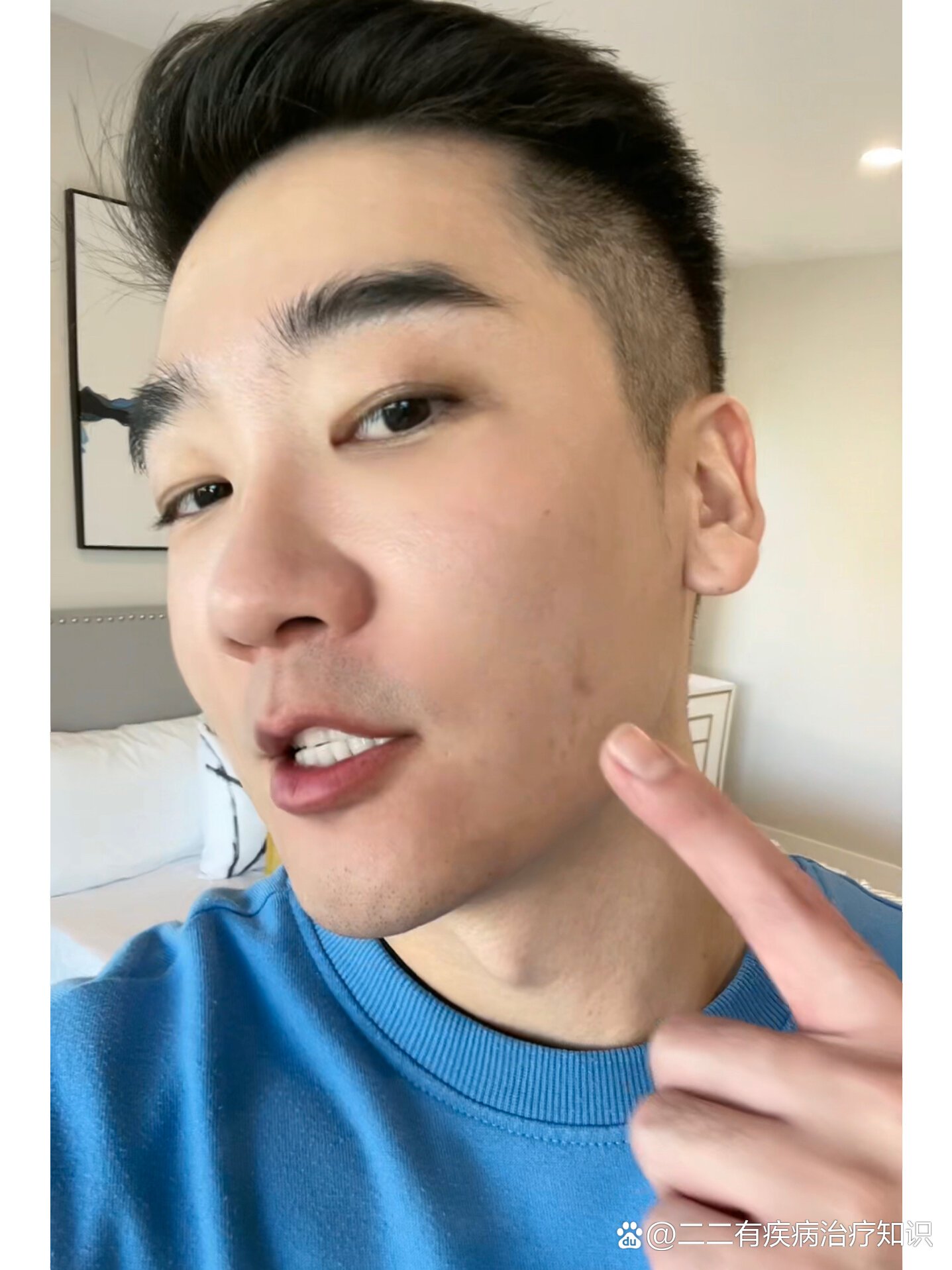 皮脂腺囊肿(粉瘤)长脸上了!