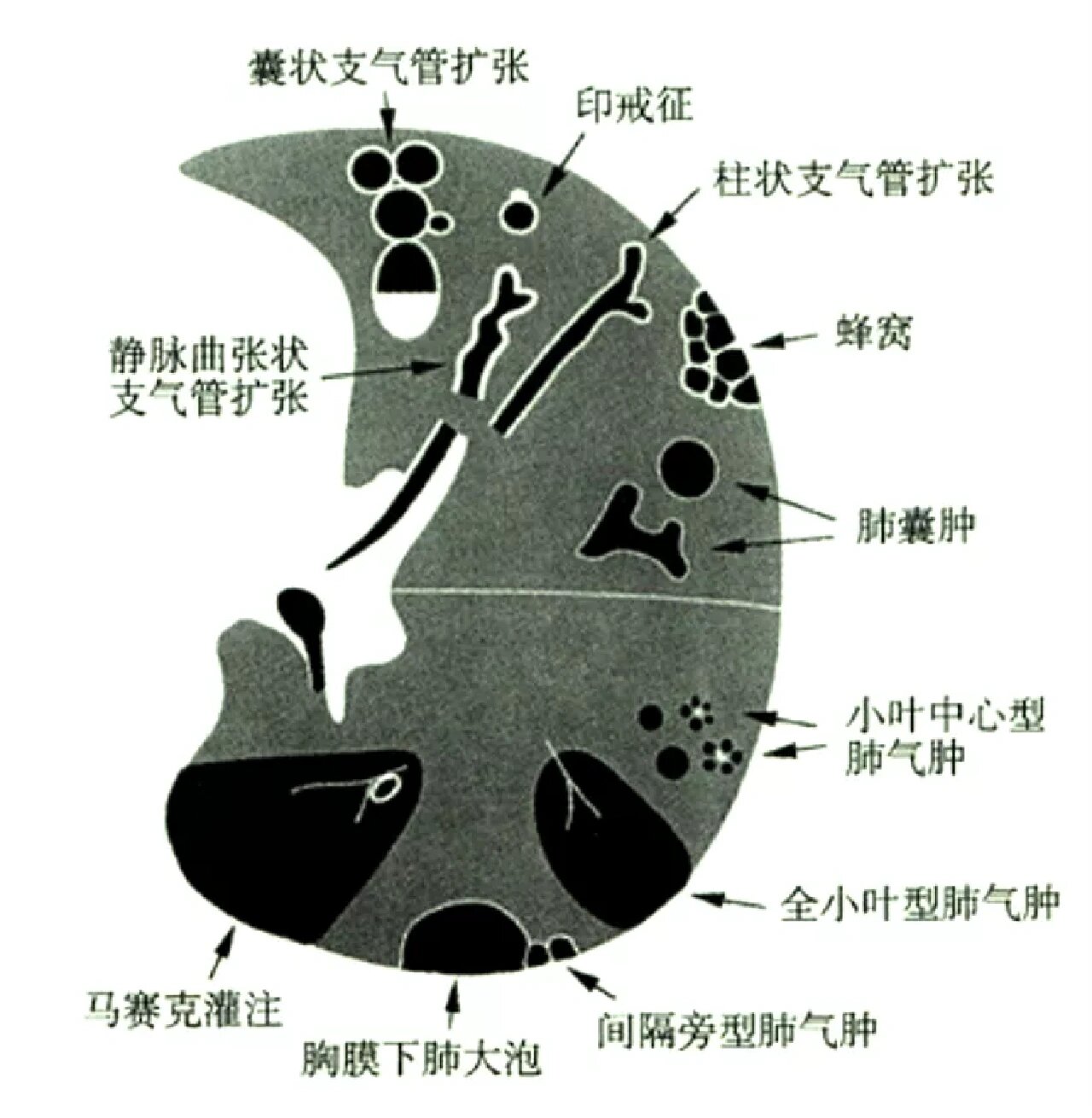 支气管囊肿图片