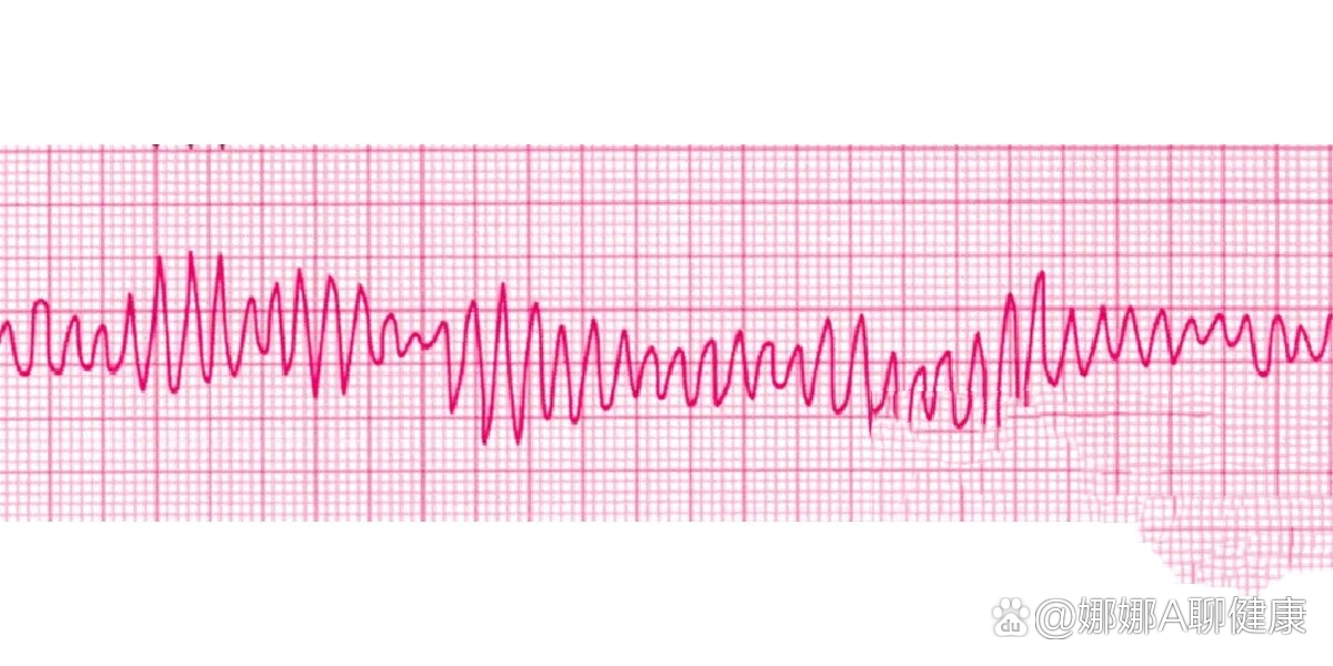 室颤的心电图图片图片
