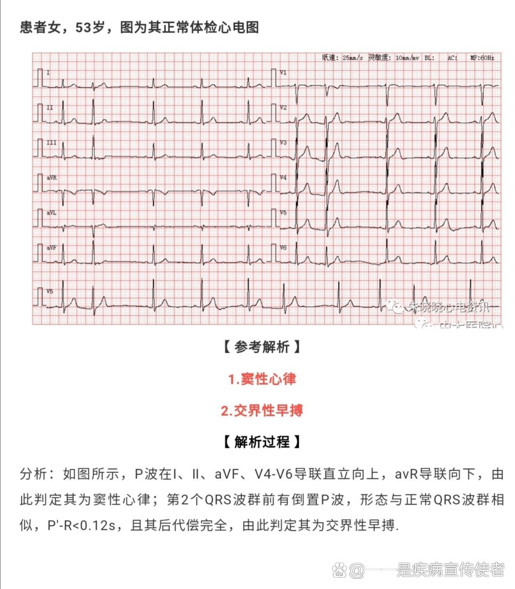 心脏早搏心电图怎么看图片