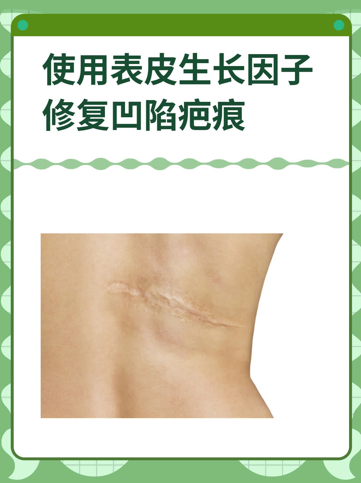 使用表皮生长因子修复凹陷疤痕